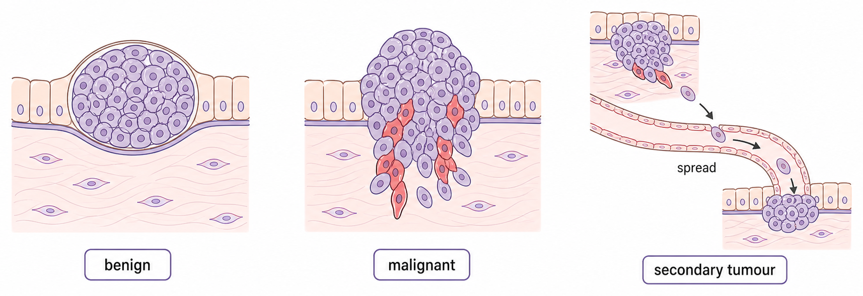 A local benign tumour is contrasted with a malignant tumour invading neighbouring tissue and with cells spreading through a vessel to form a secondary tumour.